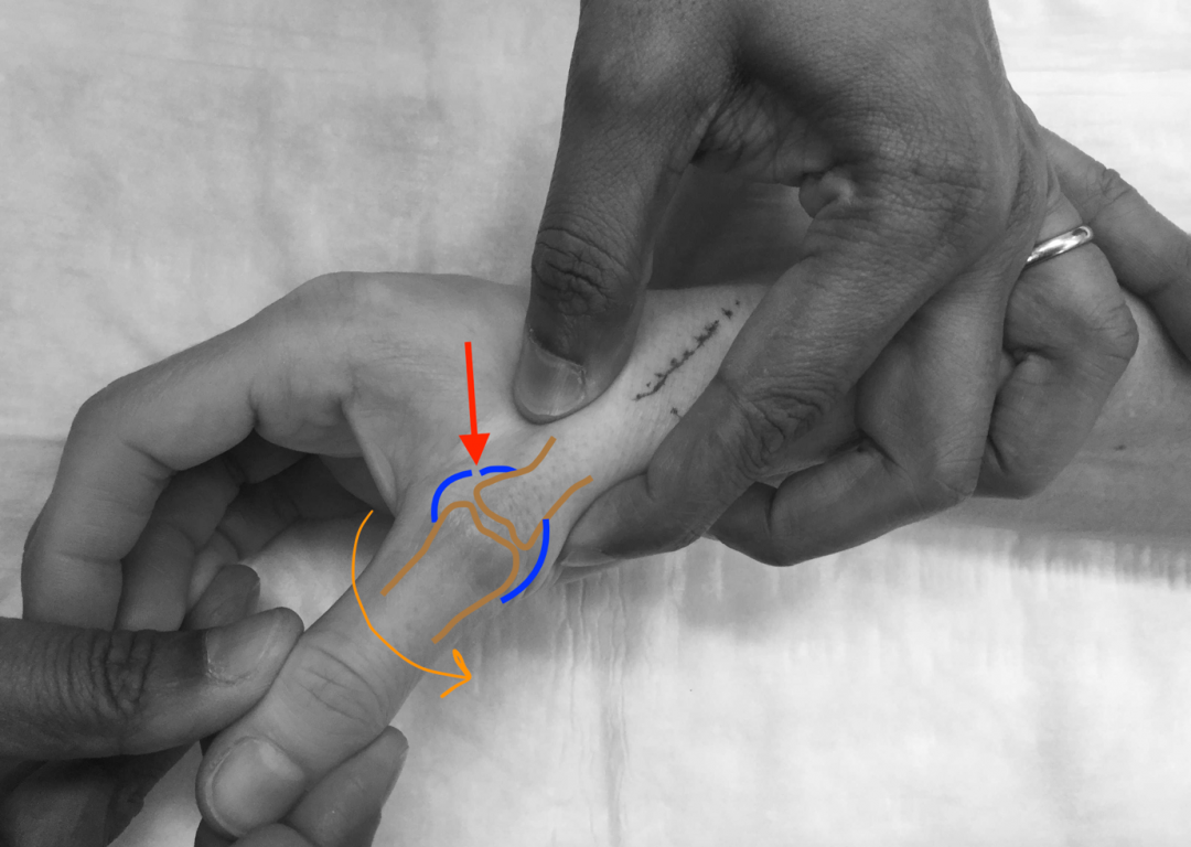 Skier's Thumb: An injury to the ulna collateral ligament of the thumb